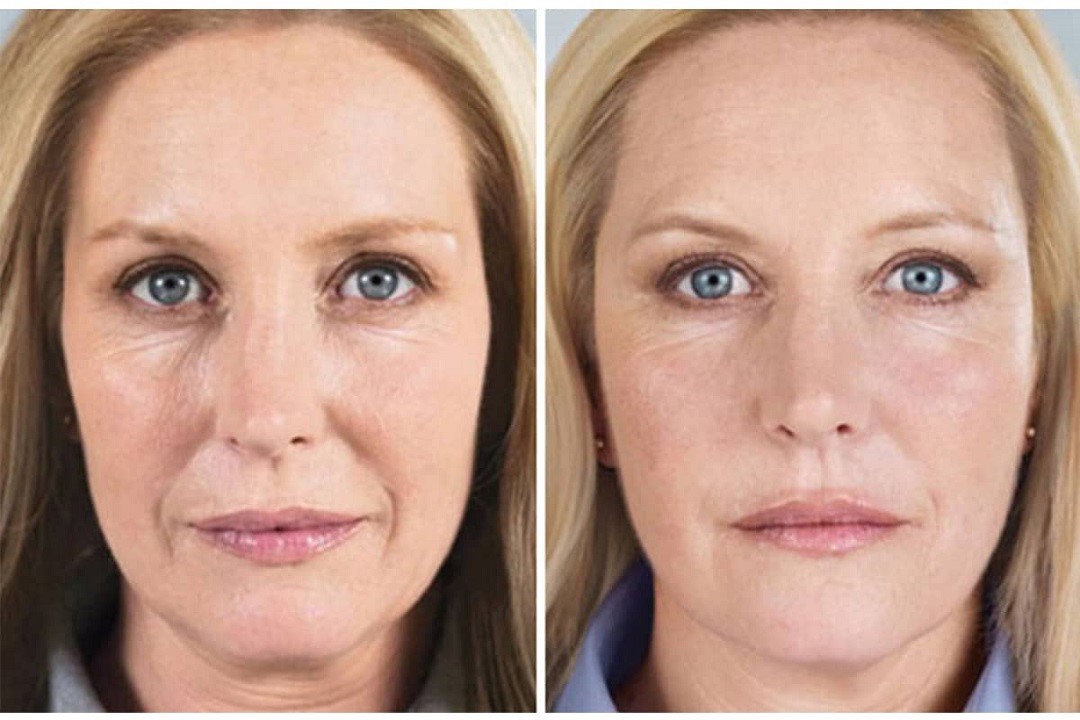 Comparing Profilo and Sculptra